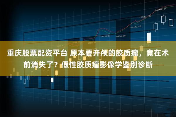 重庆股票配资平台 原本要开颅的胶质瘤，竟在术前消失了？假性胶质瘤影像学鉴别诊断